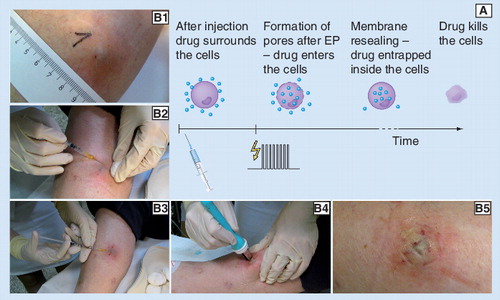 Figure 1. Electrochemotherapy (ECT) of tumors.(A) The main mechanism of ECT and (B1–5) an example of a clinical ECT procedure are presented. In this example a subcutaneous melanoma metastasis on the lower leg was treated on an outpatient basis by ECT with cisplatin: (B1) tumor before treatment; (B2) application of local anesthesia; (B3) intratumoral injection of cisplatin; (B4) application of electric pulses using parallel plate electrodes; (B5) treated area immediately after treatment. Note the bluish-pale color of the treated area in the last photograph (indication of locally arrested tumor blood flow and the beginning of edema formation). For an example of the long-term effect of ECT on a bleeding melanoma tumor see Figure 7.EP: Electroporation.