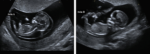 Figure 1 Images of twin A and twin B at 12 weeks.
