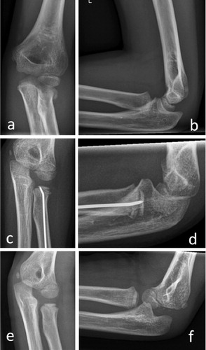 Figure 1. A 9-year-old boy sustained a radial neck fracture (Judet type-IV) with remaining bony contact of the radial neck, after falling on a level surface (panels a and b). Panels c and d show radiographs 16 days after elastic stable intramedullary nailing (ESIN). After implant removal 3 months postoperatively, there was correct positioning of the radial head and neck (panels e and f). At clinical follow-up 2.3 years after the initial trauma, the patient was free of symptoms and had full range of motion.