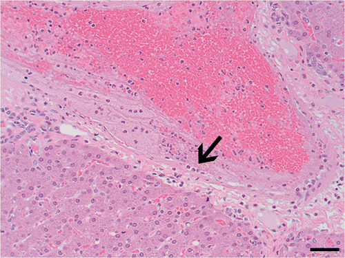 Figure 3 Vascular damage adjacent to ablated region. Fibrin and neutrophils (arrow) adhere to vascular endothelium in vessel adjacent to viable hepatocytes. H&E, 200× magnification. Bar equals 50 µm.