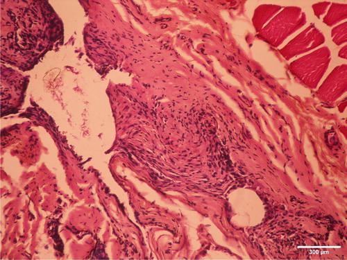 Figure 7. Slight fibrosis two months after implantation of cold polymerized acrylate in m.biceps femoris of male Wistar rats. HE, ×200.