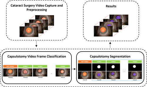 Figure 1 The propopsed two-stage capsulotomy recognition system (detection and segmentation) in cataract surgery.