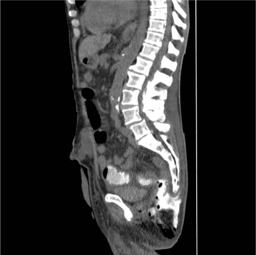 Figure 1 Computed tomography image with contrast, sagittal section, of pelvis, showing the fistula from the subcutaneous abscess cavity of the right buttock to the small intestine.