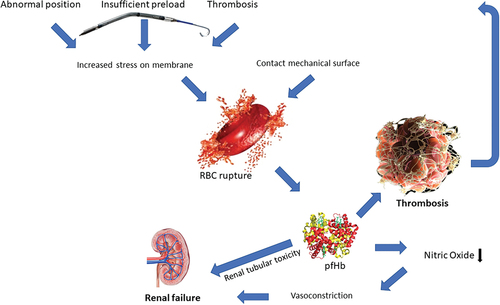 Figure 2. Pathophysiology of hemolysis during pVAD support. Abnormal position, insufficient preload and device thrombosis lead to increased red blood cell stress. When combined with artificial surface contact this can lead to red blood cell rupture (hemolysis) which releases mediators such as free hemoglobin. These mediators activate coagulation and reduce nitric oxide availability, thrombosis and renal tubular toxicity, which can be a vicious circle. RBC = red blood cell.