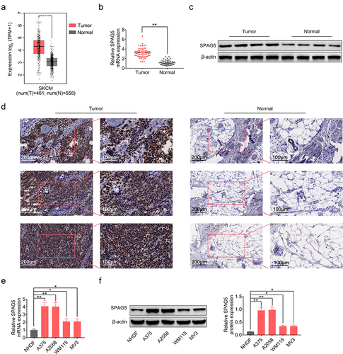 Figure 1. SPAG5 expression was increased in MM tissues and samples. (a) SPAG5 expression in MM tissues and normal tissues, as predicted in GEPIA database. (b) SPAG5 mRNA levels in 60 paired MM tissues and normal tissues were determined using qRT-PCR. (c, d) The protein levels of SPAG5 in 3 paired MM tissues and normal tissues were determined using Western blotting and IHC analysis. (e, f) The mRNA and protein expression of SPAG5 in NHDF, A375, A2058, WM115 and MV3 cell were measured by qRT-PCR and Western blotting. (n = 3, *P < 0.05, **P < 0.01).