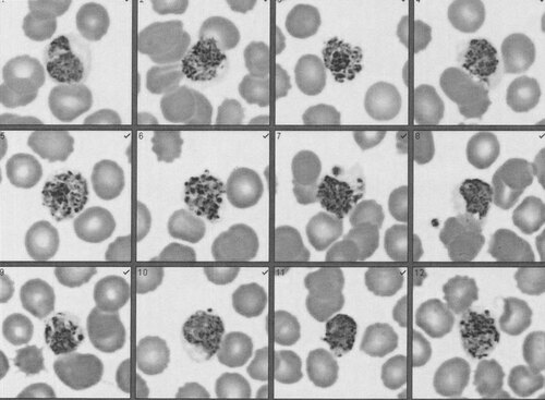 Figure 1 Blood film slides. Slides are taken from a blood film performed on 14 August and are similar to slides prepared on 13 and 16 August. Schizonts are larger than uninfected red blood cells and Schuffner’s dots are present, both characteristic of P. vivax.