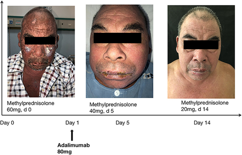 Figure 1 Representative photographs illustrate disease progression. A patient with TEN before (day 0) and after (day 14) the combination therapy.