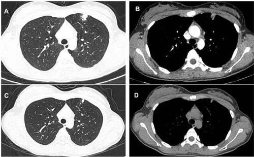 Figure 6 Case 3. Time course of CT findings in the left-superior pulmonary lobe. (A and B) A new occupying lesion in diameter of 1.4cm×0.8cm appeared after six months of chemotherapy with irregular margin and central low density. (C and D) The nodule was diminished to 1.0cm×0.3cm eight months after the initial diagnosis.