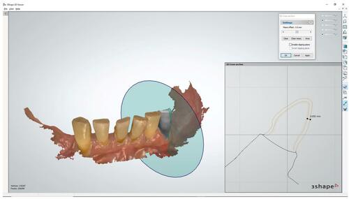 Figure 4 Design of the provisional restoration. The thickness was designed 0.65-mm.