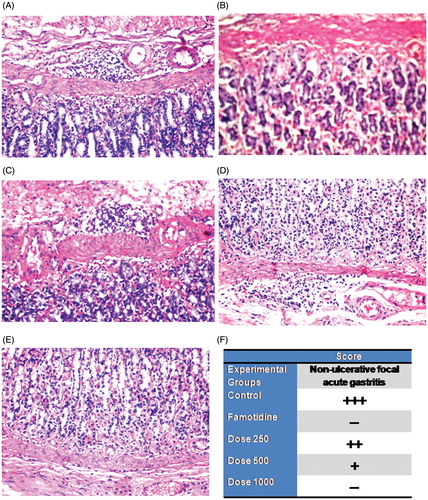 Figure 3. Photomicrographs of stomach sections of different treatment groups stained by H&E. A: Control group (vehicle treated) showing focal inflammatory cells infiltration with dilated blood vessels in submucosa (×40). B: Famotidine treated group showing normal submucosa (×40). C: Dose 250 mg/kg treated group showing focal inflammatory cells infiltration in submucosa (×40). D: Dose 500 mg/kg treated group showing focal inflammatory cells infiltration with dilated blood vessels in submucosa (×40). E: Dose 1000 mg/kg treated group showing focal inflammatory cells infiltration in base of mucosa (×40). F: Scoring the severity of the histopathological alterations (Focal inflammatory cells infiltration with dilated blood vessels in submucosa) in stomach of different experimental groups. +++: Severe histopathological alteration. ++: moderate histopathological alteration. +: mild histopathological alteration. –: nil histopathological alteration.