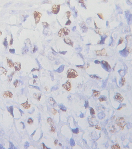 Figure 2 Ki-67 expression in PGI-DLBCL (ileum) (400×). Ki-67 was localized to the nucleus of PGI-DLBCL cells.