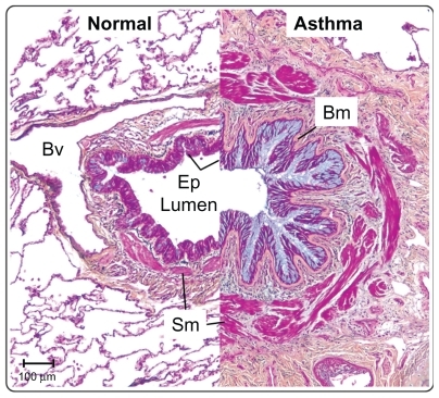 Figure 2 The airways in asthma undergo significant structural remodeling. Medium-sized airways from a normal individual and a severe asthmatic patient were sectioned and stained using Movat’s pentachrome stain. The epithelium in asthma shows mucous hyperplasia and hypersecretion (blue), and significant basement membrane (Bm) thickening. Smooth muscle (Sm) volume is also increased in asthma. Scale bar 100 μm.