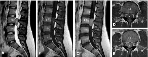 Figure 1 MRI-based visualization of the the tumor process (*) located in the lumbar spinal canal behind the third lumbar vertebral body (L3). (A) Mid-sagittal T2-weighted MRI, (B) Mid-sagittal T1-weighted MRI, (C) Mid-sagittal T1-weighted MRI with contrast (Clariscan), (D) Axial T1-weighted MRI, (E) Axial T1-weighted MRI with contrast (Clariscan).