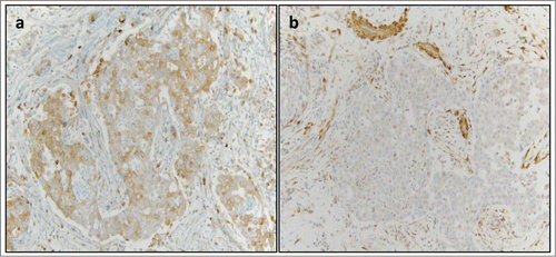 Figure 3. Immunohistochemical Identification of Molecular Targets for Therapy. (A) Negative expression of RRM1 (defined as less than 2+/50%) was detected in the patient sample (1+/90%). (B) Negative expression of PTEN (defined as ≤1+/50%) was detected in the patient sample (1+/5%, a near complete loss of expression).