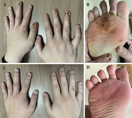 Figure 2 Treatment of multiple plantar and periungual warts in the patient with local hyperthermia. (A and B) Warts around the nails, and on the right plantar before treatments (By the first visit, warts and nails had become discolored due to topical TCM) (C and D) After 11 treatments, almost all warts disappeared.