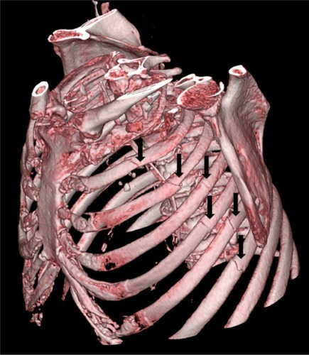 Figure 1 An 82-year-old woman who suffered from a motor vehicle accident.