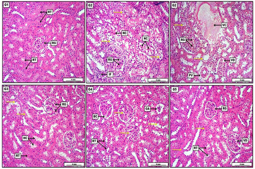 Figure 5 Photomicrograph of kidney from groups; (G1): Negative control group received (D.W), display no prominent lesions, apparent by distinctive renal glomeruli (RG), in addition, renal tubules (RT) show no significant lesions except for mild and non-significant cellular swelling. (G2): Positive control group received (D.W) and 5-fluorouracil (5-FU) 150 mg/kg. Renal tubular epithelia show significant and severe vacuolar swelling (yellow arrows) evident by pale enlarged cytoplasm, together with the presence of a profound number of necrotic cells manifested by pycnotic nuclei and acidophilic cytoplasm. The section reveals interstitial infiltration of inflammatory cells (IF), in addition to pycnotic nuclei within the renal glomerular endothelial cells (G3): Telmisartan 10 mg/kg and a single dose of 5-fluorouracil (5-FU) 150 mg/kg, express moderate cellular swelling within the renal tubular epithelia (yellow arrows) in addition to the presence of some vacuolar change inside the glomerular endothelial cells (RG). Moreover, the section shows mild eosinophilic hyaline cast (HC) within the tubular lumen. (G4): Quercetin (80 mg/kg) and a single dose of 5-FU 150 mg/kg, display significant cellular swelling within the lining tubular epithelial and glomerular cells (yellow arrows), together with the incidence of pycnotic nuclei in the renal tubular epithelia (RT). In addition, the section also shows obvious glomerular atrophy (GA) which is simultaneous with minor dilation of Bowman’s capsule. (G5): Telmisartan 10 mg/kg and quercetin (80 mg/kg) with a single dose of 5-FU 150 mg/kg, displays moderate cellular swelling in the renal tubular epithelial cells (RT), with the slight deposition of deep pinkish proteinaceous materials within the tubular lumina (yellow arrows). Additionally, there is some mild vacuolar degeneration (VD) within the endothelial lining of renal glomerular capillaries (RG). H&E. Scale bar: 4 mm.