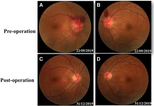 Figure 1 Fundus photography. The swelling and blurry boundaries of both optic nerves were present (A and B). There was a splinter radial superficial retinal hemorrhage above the optic disc; no other obvious abnormality was observed (A and B). Three months after surgery, all these symptoms, including optic nerve swelling and retinal hemorrhage disappeared (C and D).