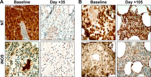 Figure 4 Representative images of NT and iNOS from limited on-treatment tumor biopsies for two patients with metastatic melanoma.