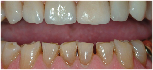 Figure 5. A clinical image demonstrating wear facets on teeth nos. 22, 23, 27 and 28 opposing lithium disilicate crowns.