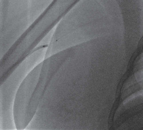 Figure 3. Guiding catheter successfully advanced to branchial artery after BAT technique.