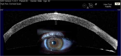 Figure 4 A 42-year-old male patient had penetrating keratoplasty in his left eye 9 years earlier due to advanced keratoconus.