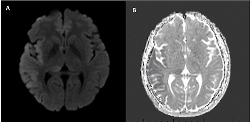 Figure 1 (A) initial DWI Shows hyperintensity in the right temporoparietal lobe consistent with diffusion restriction. (B) hypointensity in the right temporoparietal region in line with the hyperintensity in the DWI.