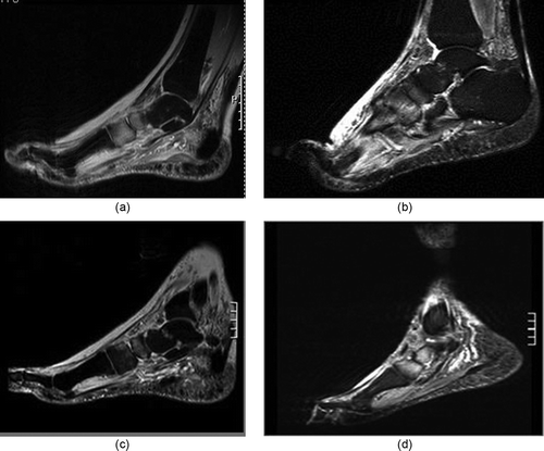 Figure 1. (a) Baseline diagnostic MRI of active-stage Charcot foot grade 0, four weeks after symptom onset. Sagittal STIR sequence showing EESC of tarsal bones (bright appearance), and soft tissue. (b) Same foot as in (a). First follow-up MRI after 6 weeks of unloading and immobilizing. Merely unchanged EESC, as compared to (a). (c) Second follow-up MRI after 11 weeks of treatment. Regression of bone and soft EESC (as compared to (a) and (b)). Unprotected normal weight-bearing was resumed immediately, without weaning. (d) Follow-up MRI after 21 weeks of unprotected re-loading. Relapse of bone EESC, now with tarsal fractures, soft-tissue edema, and collapse of the longitudinal arch, consistent with active-stage Charcot foot grade 1.