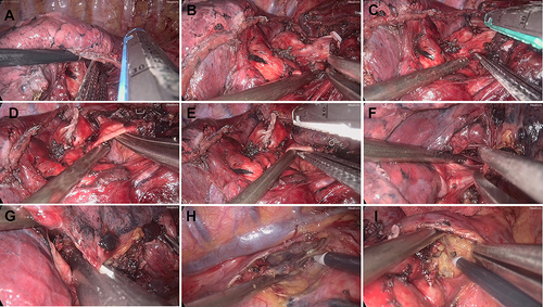 Figure 2 Appropriate instruments inserted through a 5mm incision enhance surgical exposure, enable efficient tissue mobilization, and allow for the precise deployment of a surgical stapler. (A) Transecting the oblique fissure. (B) Circling the bronchus of the right upper lobe. (C) Transecting the bronchus of the right upper lobe. (D) Circling the arterial branch of the right upper lobe. (E) Transecting the arterial branch of the right upper lobe. (F) Circling the vein of the right upper lobe. (G) Transecting the vein of the right upper lobe. (H) Lymphadenectomy of the 2nd and 4th nodal stations. (I) Lymphadenectomy of the 7th nodal station.