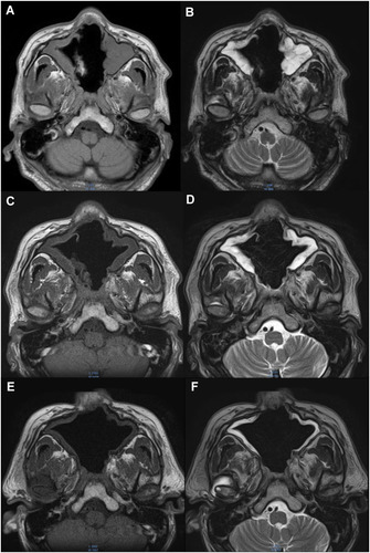 Figure 5 MRI findings along with clinical course. Horizontal views of (A and C and E) T1-weighted, and (B and D and F) T2-weighted images at the level of the maxillary sinus after endoscopic sinus surgery (A and B), before the additional operation (C and D), and five months after the additional operation (E and F).