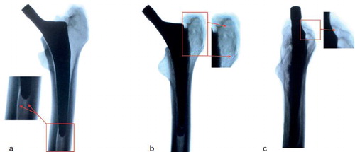 Figure 3. (a) Radiograph of the fracture of the femur with a cementless stem, anteroposterior view. (b) Radiograph of the fracture of the femur with a cemented stem, anteroposterior view. (c) Radiograph of the fracture of the femur with a cemented stem, lateral view.