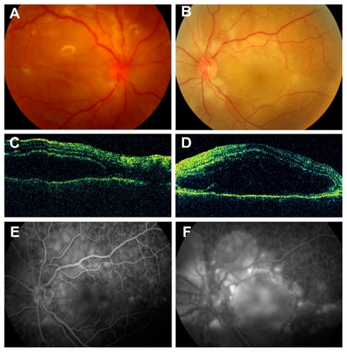 Figure 1 Images obtained after the onset of sympathetic ophthalmia. Fundus photograph of the right (A) and left eye (B); optical coherence tomography images of the right (C) and left eye (D) fundi; early-phase (E) and late-phase (F) fluorescein angiography of the left eye.