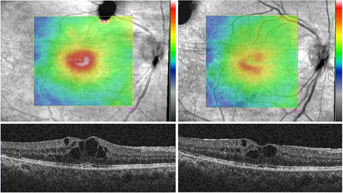 Figure 1 Reduction of CRT Following PBM Treatment. OCT imaging for the selected subject showed a reduction of CRT and HE following PBM treatment.