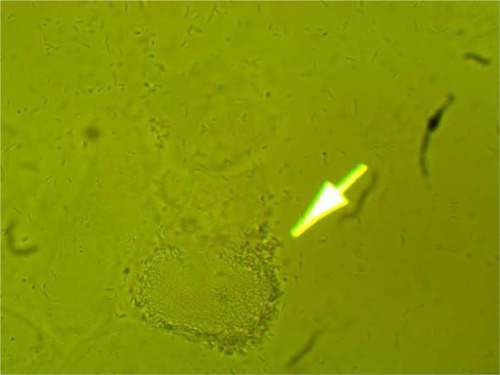 Figure 6 Clumping of lactobacilli with circular ridge formation.