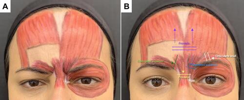 Figure 1 (A) Representation of muscle groups involved in glabellar frown lines. (B) Schematic representation of glabellar lines perpendicular to the direction of each underlying muscle.