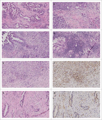 Figure 1. (A) Stromal TIL negative group (score 0): almost no lymphocytic infiltration into the stroma of surrounding cancer cell nests; (B) Stromal TIL negative group (score 1): low lymphocytic infiltration into the stroma of surrounding cancer cell nests; (C) Stromal TIL positive group (score 2): moderate lymphocytic infiltration into the stroma without tumor cell nest permeation and (D) Stromal TIL positive group (score 3): intense lymphocytic infiltration into the stroma and between tumor cells. (E) and (F): Representative figure of stromal TILs at modetate scores in the same tissue section verified by HE and the expression of CD45 by immunohistochemistry, respectively. (G) and (H): Representative figure of stromal TILs at low scores based on HE stainings in the same tissue section verified by the expression of CD45 by immunohistochemistry. [100 × magnification, H & E-stained sections or IHC sections. (A-E, G); 100 × magnification, IHC section (F, H)]. Abbreviations: TIL = tumor-infiltrating lymphocyte.