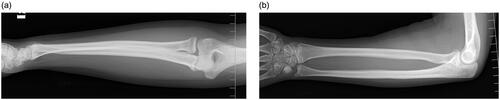 Figure 4. Anteroposterior (a) and lateral (b) views of radiographs 4 years after surgery.