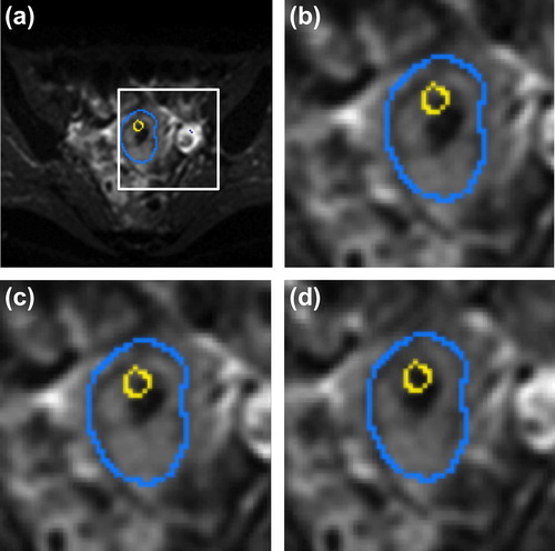 Figure 2. DW-MRI, b = 0 s/mm2, for the three different image sets with GTV (blue contour) and delineated tandem center (yellow contour): (a) non-corrected with full FOV where the white square indicate the zoomed in area shown in the three other images: (b) non-corrected, (c) B0M, (d) DIR.