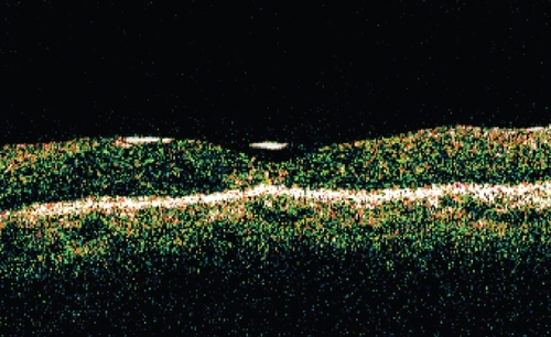 Figure 1 Optical coherence tomography image of silicone oil-fluid interface over the foveal depression in a patient without associated vision loss.