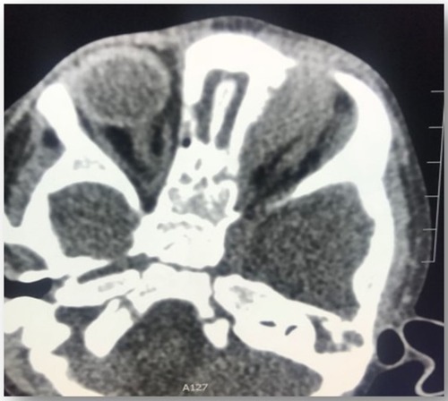 Figure 3 Non-enhanced axial view CT of head and orbit, showing ill-defined soft tissue mass at the medial aspect of left orbit causing lateral displacement of left globe.