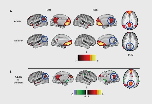 Figure 4. Development of functional connectivity. Voxelwise resting-state functional connectivity maps for a seed region (solid black circle) in medial prefrontal cortex—mPFC (ventral: -3, 39, -2). (A) Qualitatively, the resting-state functional connectivity MRI (rs-fcMRI) map for the mPFC (ventral) seed region reveals the commonly observed adult connectivity pattern of the default network. The connectivity map in children, however, significantly deviates from that of the adults. Functional connections with regions in the posterior cingulate and lateral parietal regions (highlighted with blue open circles) are present in the adults but absent in children. (B) These qualitative differences between children and adults are confirmed by the direct comparison (random effects) between adults and children. mPFC (ventral) functional connections with the posterior cingulate and lateral parietal regions are significantly stronger in adults than children. Reproduced from ref 60: Fair DA, Cohen AL, Dosenbach NUF, et al. The maturing architecture of the brain's default network. Proc Natl Acad Sci U S A. 2008;105:4028-4032. Copyright © National Academy of Sciences 2008