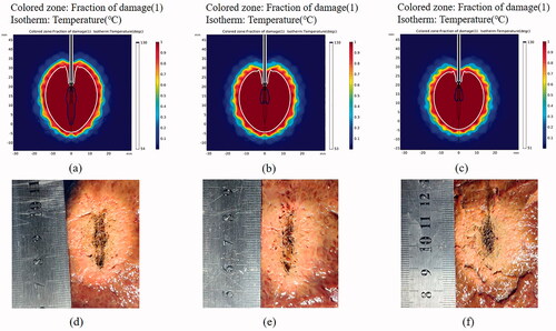 Figure 6. Numerical simulation (upper row) and experimental results (lower row) in the ex vivo porcine liver tissues after various MWA treatments. The tissues were treated under intermittent ablation with 5 s heating followed by a pause time of (a, d) 10 s, (b, e) 15 s and (c, f) 20 s for each cycle. The total ablation time in all the conditions is 300 s, and the output power is 50 W.