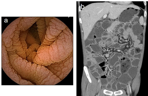 Figure 3 (a) Capsule endoscopy showing mucosa of the jejunum in patient 3, which were were congested and thinned out, with blunting of the intestinal villi. (b) CTE of the small intestine in patient 3 showed multiple, slightly enlarged lymph nodes in the peritoneal and mesenteric regions.