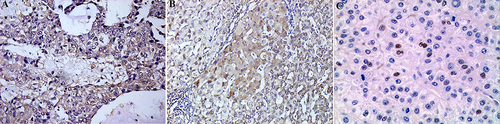Figure 3 Expression of MIFmRNA. (A) Positive expression of MIFmRNA in HCC×200. (B) Positive expression of MIFmRNA in HBV-LC×200. (C) Negative expression of MIFmRNA in normal liver tissue×200.