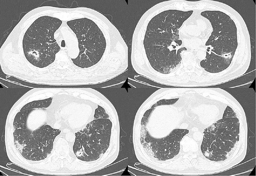 Figure 1 CT Chest on April 11th, 2023 (multiple patchy solid and ground glass opacifications in both lungs, partial cavitary formation, and subpleural mesh lattice changes in the lower lobe of both lungs).