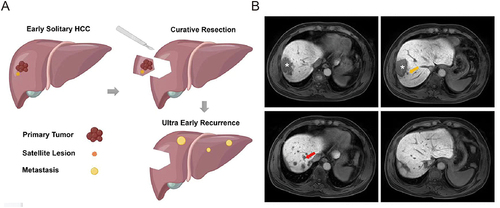 Figure 2 (A) Schematic diagram; (B) Case: Male, 54 years old. On August 9, 2017, liver-specific contrast-enhanced MRI showed a solitary lesion (asterisk) in the right lobe of the liver, with a fusion nodular type of growth and multiple satellite nodules (yellow arrows) in the surrounding area. Preoperative AFP, GGT, ALP, and PT levels were 4881 ng/mL, 127 U/L, 87 U/L, and 13s, respectively. The postoperative pathological diagnosis was hepatocellular carcinoma. On January 3, 2018, liver-specific contrast-enhanced MRI showed multiple nodular lesions (red arrows) in the liver, but no obvious mass was observed in the surgical area.