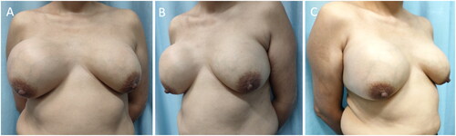 Figure 1. PASH patient before surgery. (A – C) Pre-surgery photographs taken from different angles, indicating breast asymmetry. The right breast was significantly larger than the left, and mild venous dilatation can be observed on the surface of both breasts. PASH, Pseudoangiomatous stromal hyperplasia.