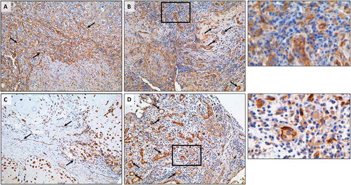 Figure 8. Heterogeneous expression of B7-H3 and IDO1 in osteosarcoma tissue. (A, C) Representative images of (A) B7-H3 and (C) IDO1 immunohistochemistry demonstrating immunoreactivity in malignant cells and tumor-associated vasculature. (B, D) Variable expression of (B) B7-H3 and (D) IDO1 in lymphoid aggregates. Black boxes indicate enlarged regions of interest (to the right of each panel). Black arrows denote tumor vasculature. Scale bar = 50#181;m.