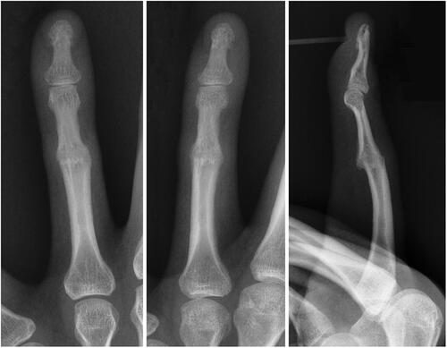 Figure 3. Plain radiographs of the left ring finger after 6 weeks immobilization demonstrating mature trabecular bridging across the PIP joint.