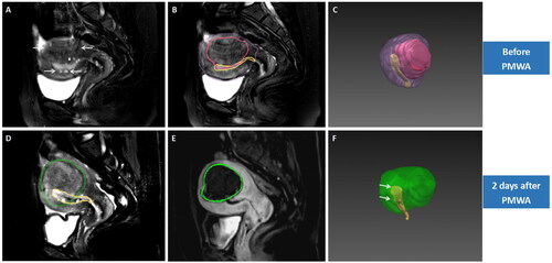 Figure 5. 3D reconstruction of MRI before and after ablation in a case of diffuse adenomyosis with bilateral myometrium involved (type IV). A 44 year-old woman who presented with HMB and frequent menses, had diffuse adenomyosis (arrows) with bilateral myometrium involved (type IV) (A). 3D reconstruction of pre-ablation MRI showed that the volume of uterine corpus, adenomyotic lesion and endometrium was obtained as 187.5 ml, 76.5 ml, and 4 ml respectively, and the baseline ISA of EMJ was 28.9 cm2 (B,C). Post-ablation MRI showed obvious decrease in the SI of the endometrium (D), and no perfusion was observed on the ipsilateral EMJ (arrows) (E). 3D reconstruction map after treatment showed that more than half of the endometrium was wrapped by the ablation zone (arrows) (D & F). The NPVr reached 93.6 %, and the ablation rate of EMJ was 84.4 %. During the follow-up, this patient had CR of AUB at 3, 6 and 12 months after treatment.
